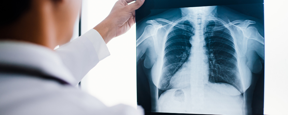 Chest & TB Department at Suraj Hospital